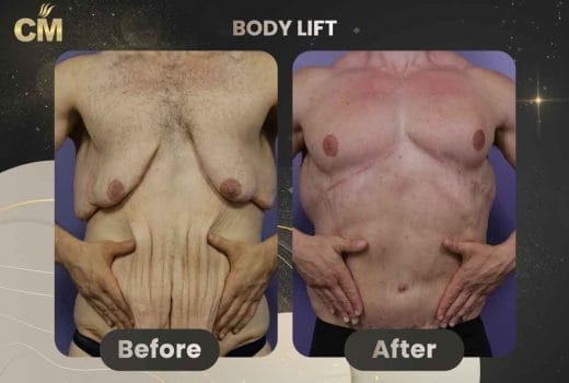 Body Lift skin removal surgery
