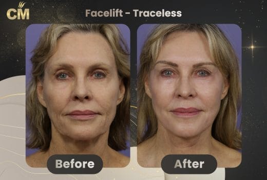 endoscopic facelift before and after