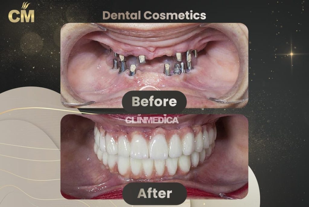 Dental Implants Before and After in Turkey-5