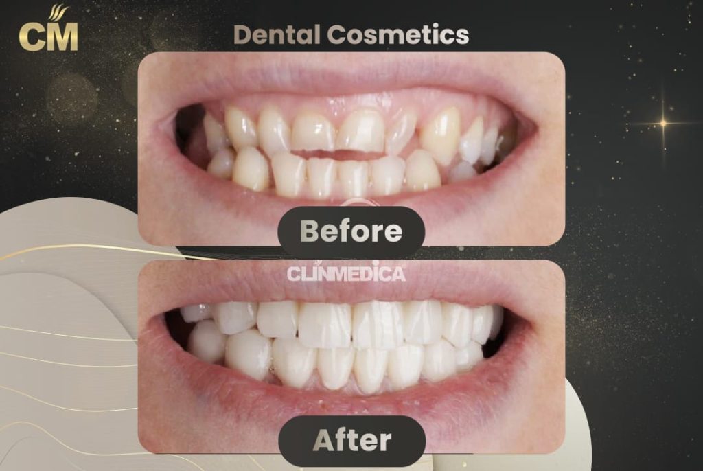 Dental Cosmetics Before and After in Turkey