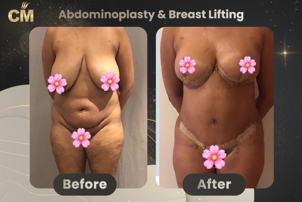 Tummy Tuck Before and After