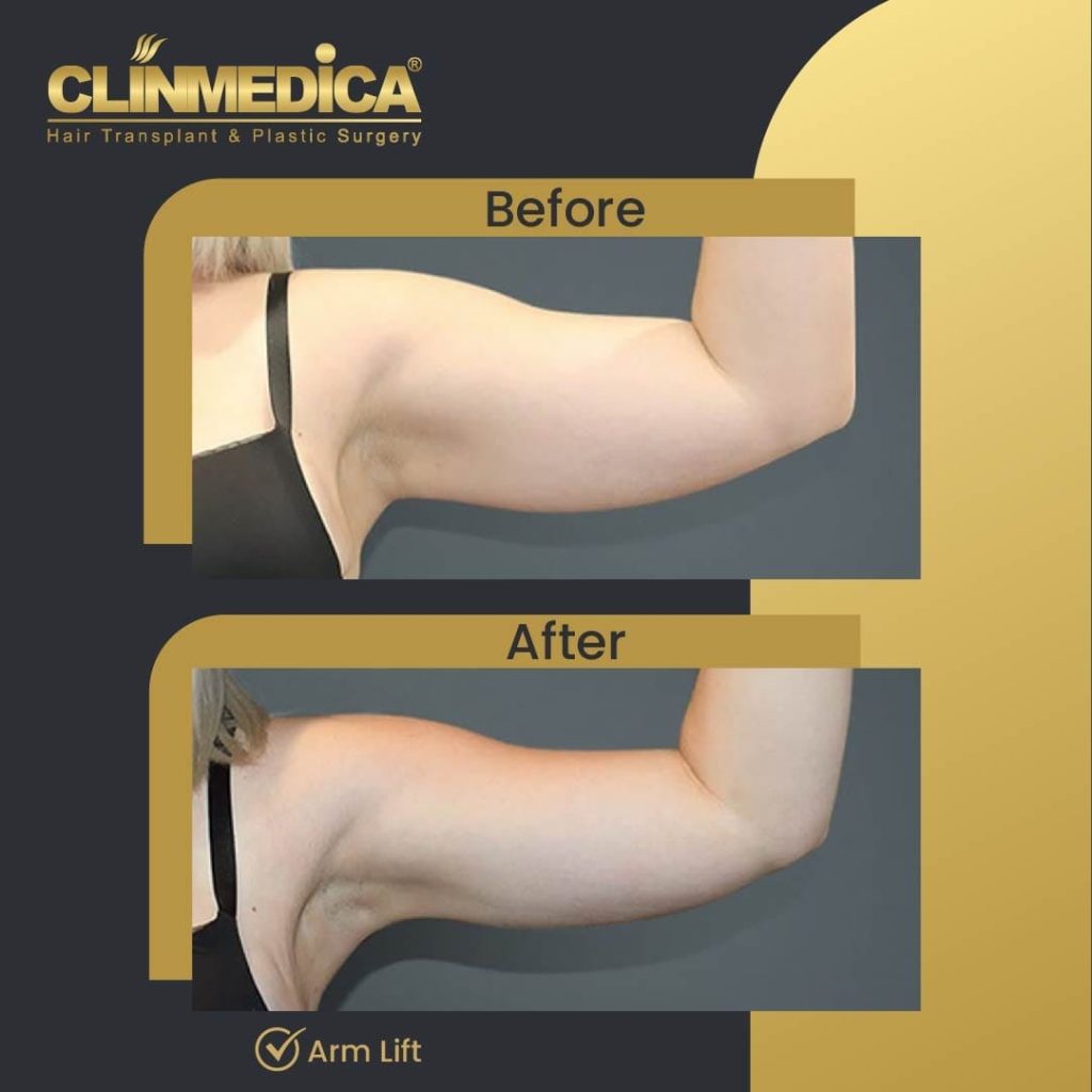 Arm Lift Before and After in Turkey