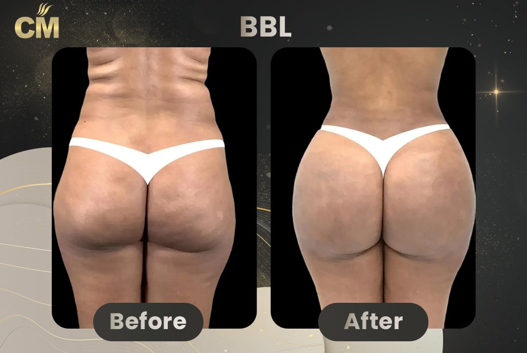 BBL Brazilian Butt Lift Before and After in Turkey-20