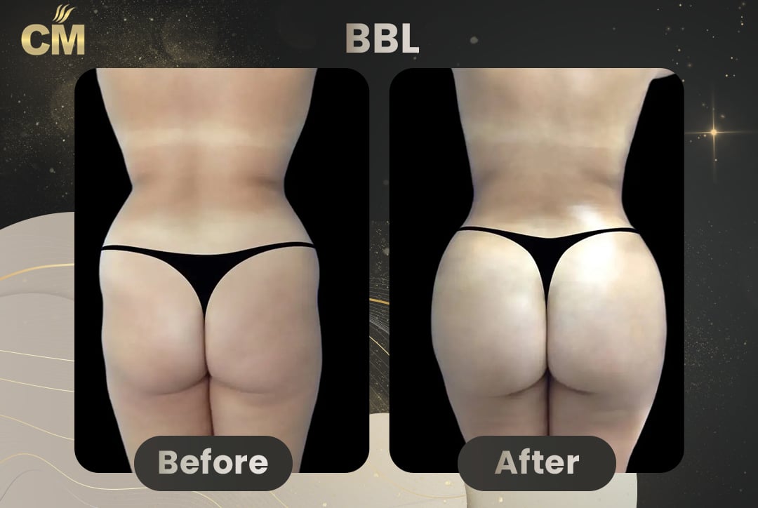 BBL Brazilian Butt Lift Before and After in Turkey-9