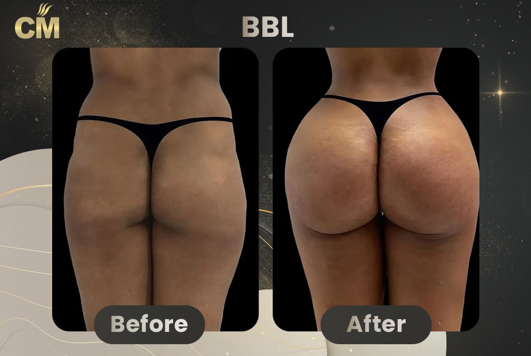 BBL Brazilian Butt Lift Before and After in Turkey-10