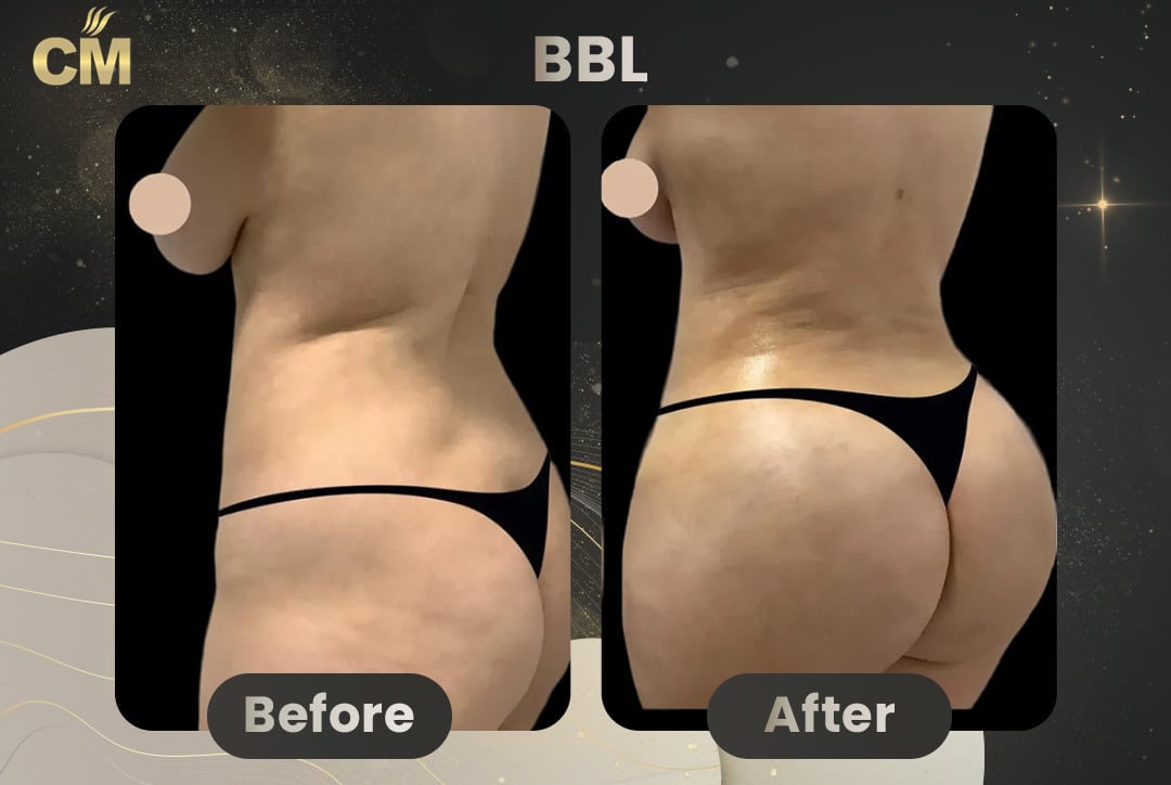 BBL Brazilian Butt Lift Before and After in Turkey-11