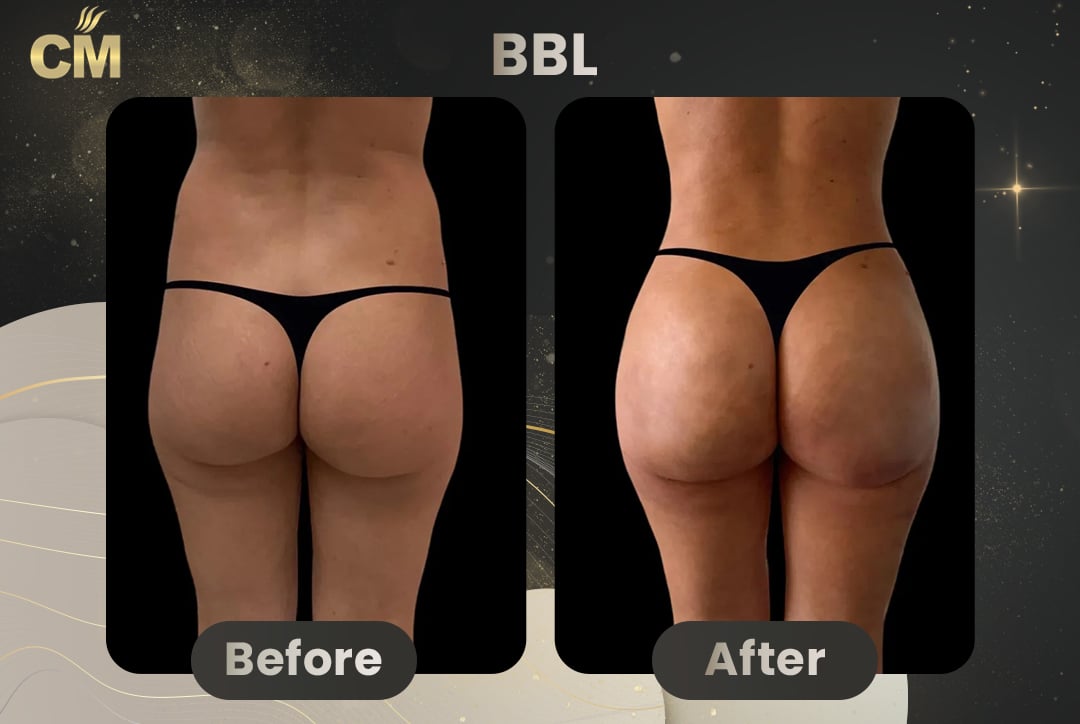BBL Brazilian Butt Lift Before and After in Turkey-12