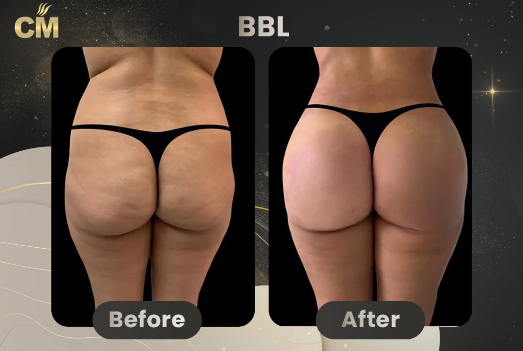 BBL Brazilian Butt Lift Before and After in Turkey-13