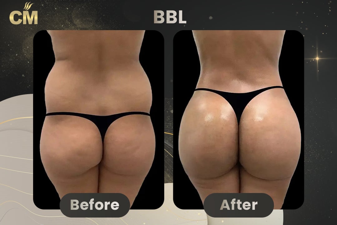 BBL Brazilian Butt Lift Before and After in Turkey