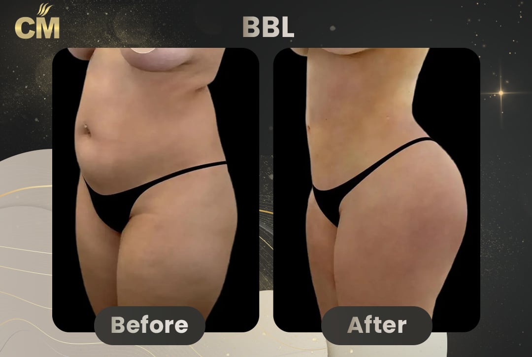 BBL Brazilian Butt Lift Before and After in Turkey-1