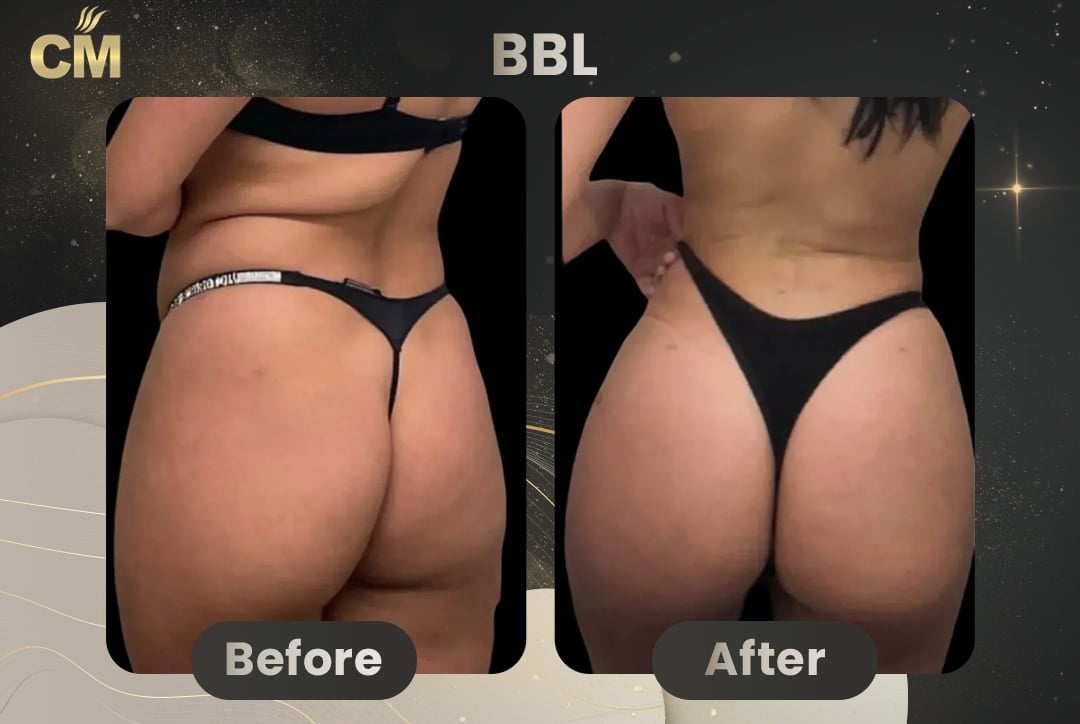 BBL Brazilian Butt Lift Before and After in Turkey-2