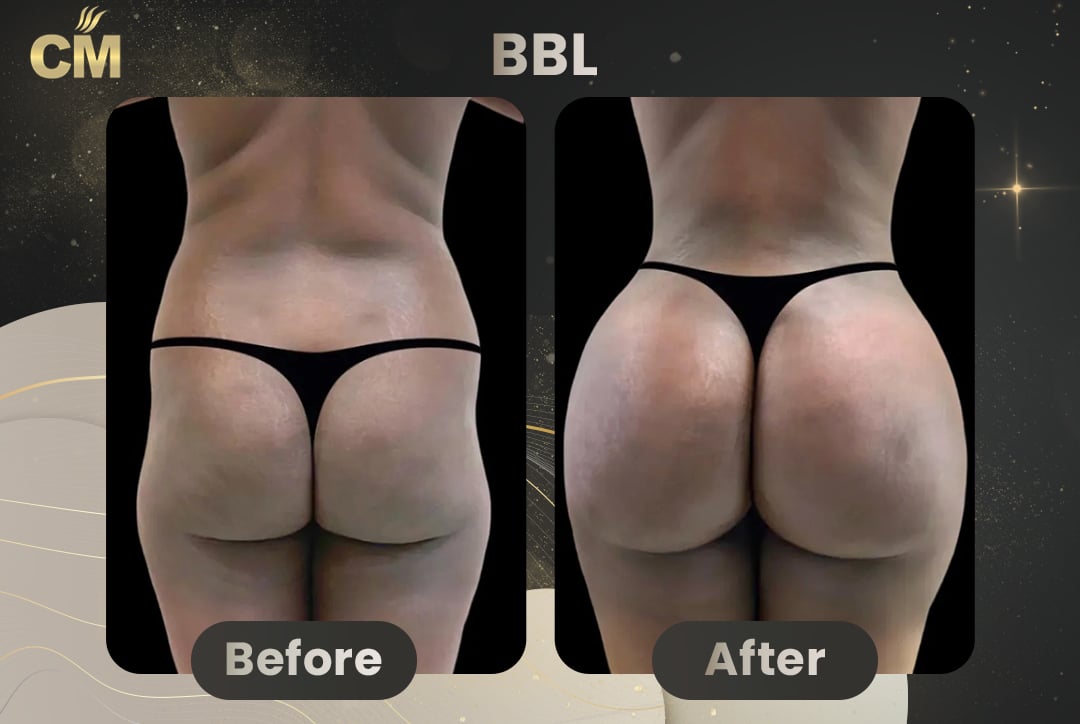 BBL Brazilian Butt Lift Before and After in Turkey-3