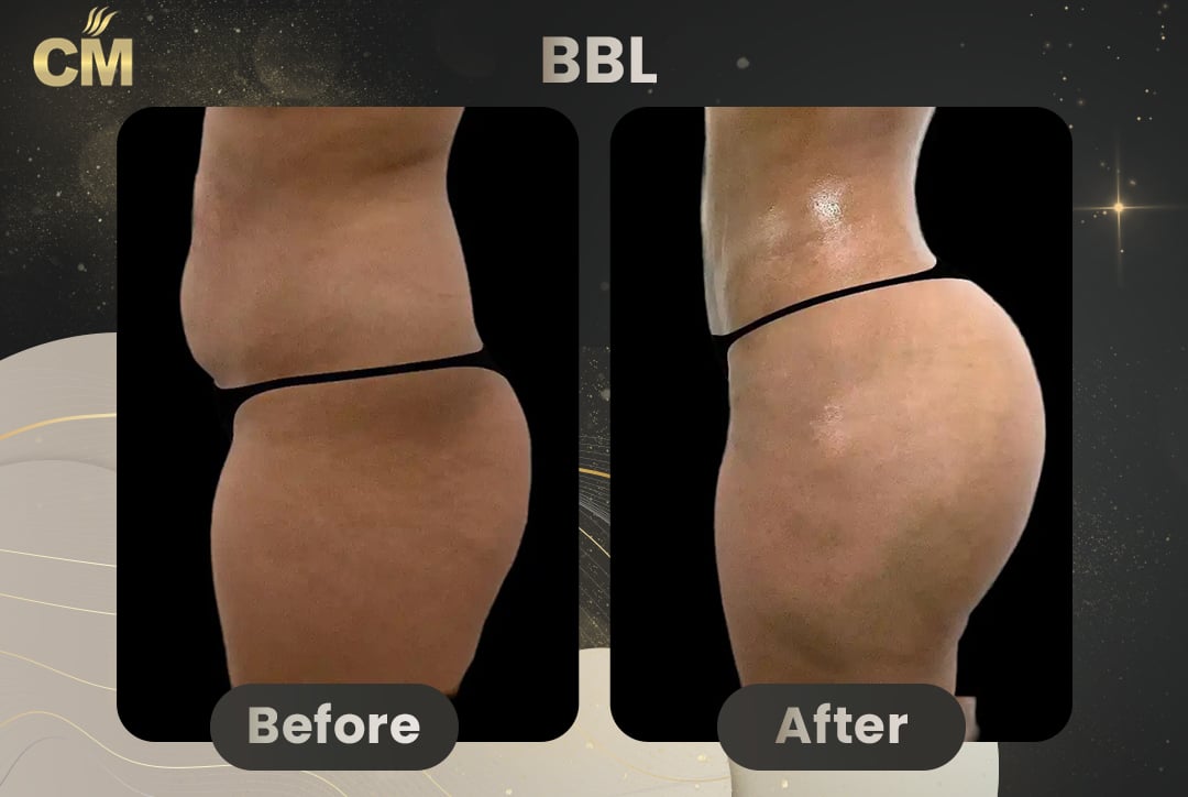 BBL Brazilian Butt Lift Before and After in Turkey-4