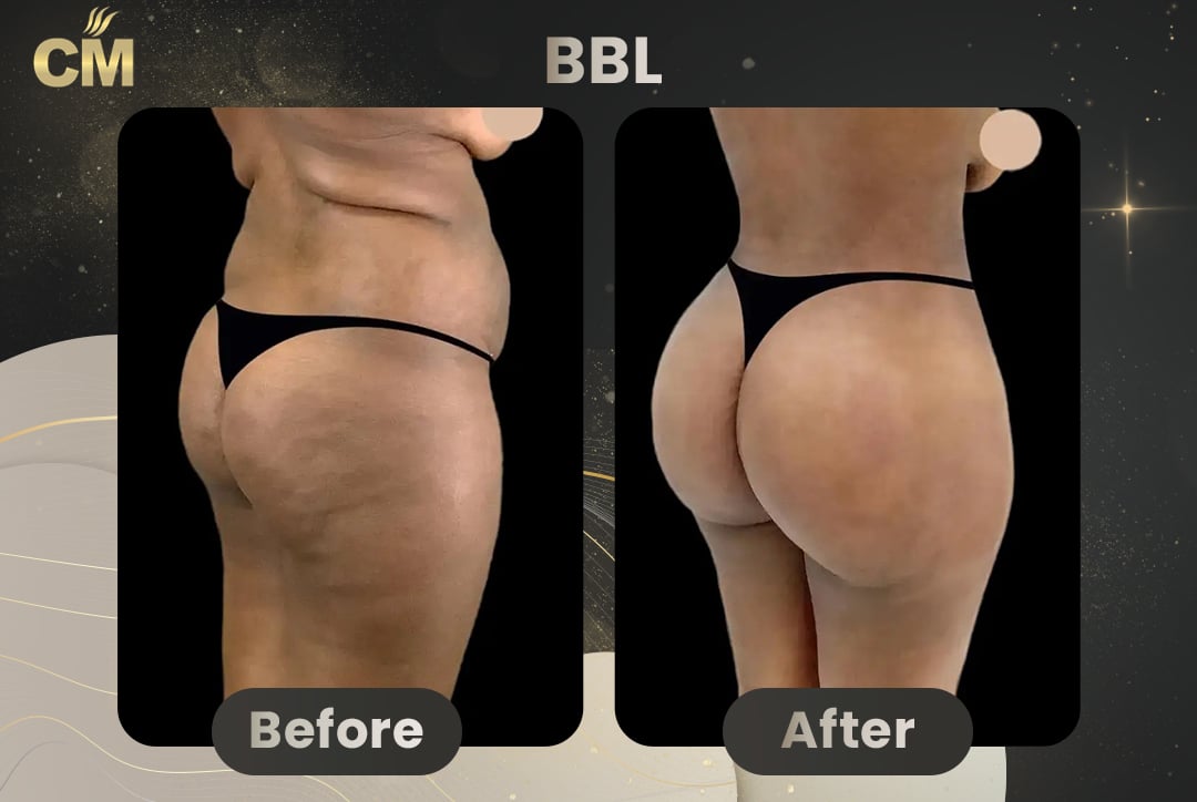 BBL Brazilian Butt Lift Before and After in Turkey-5