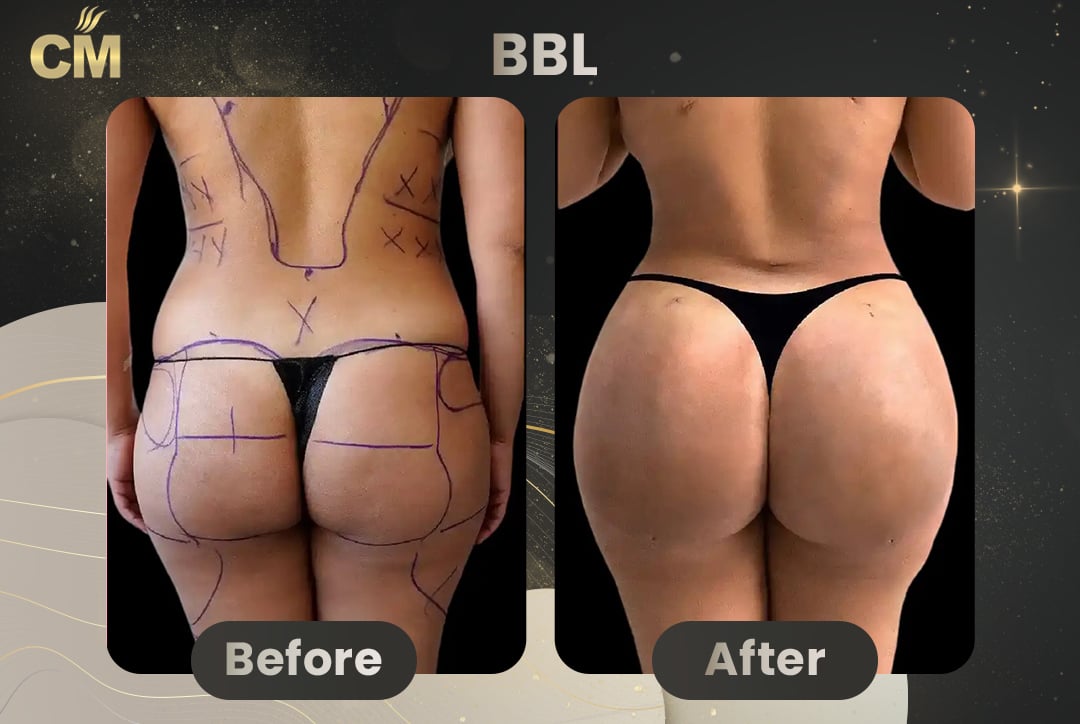 BBL Brazilian Butt Lift Before and After in Turkey-7