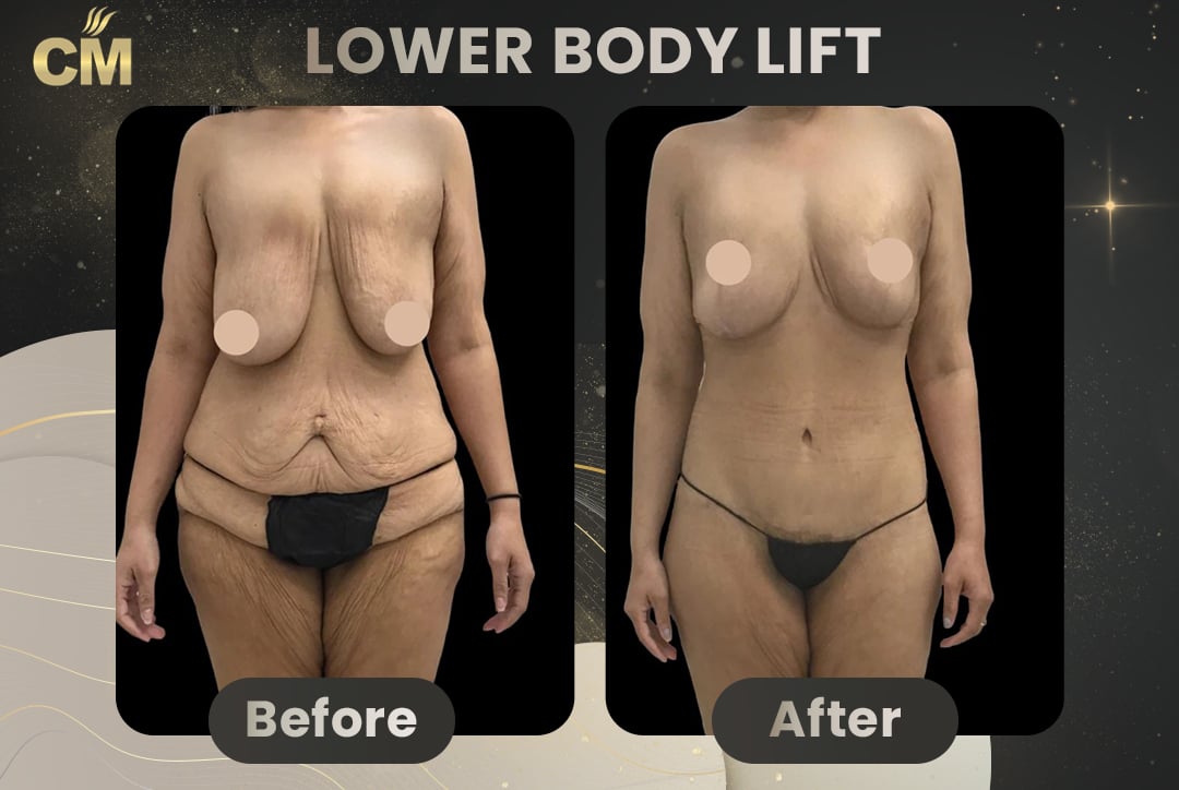 Back Lift (Bra Line Back Lift) Before After