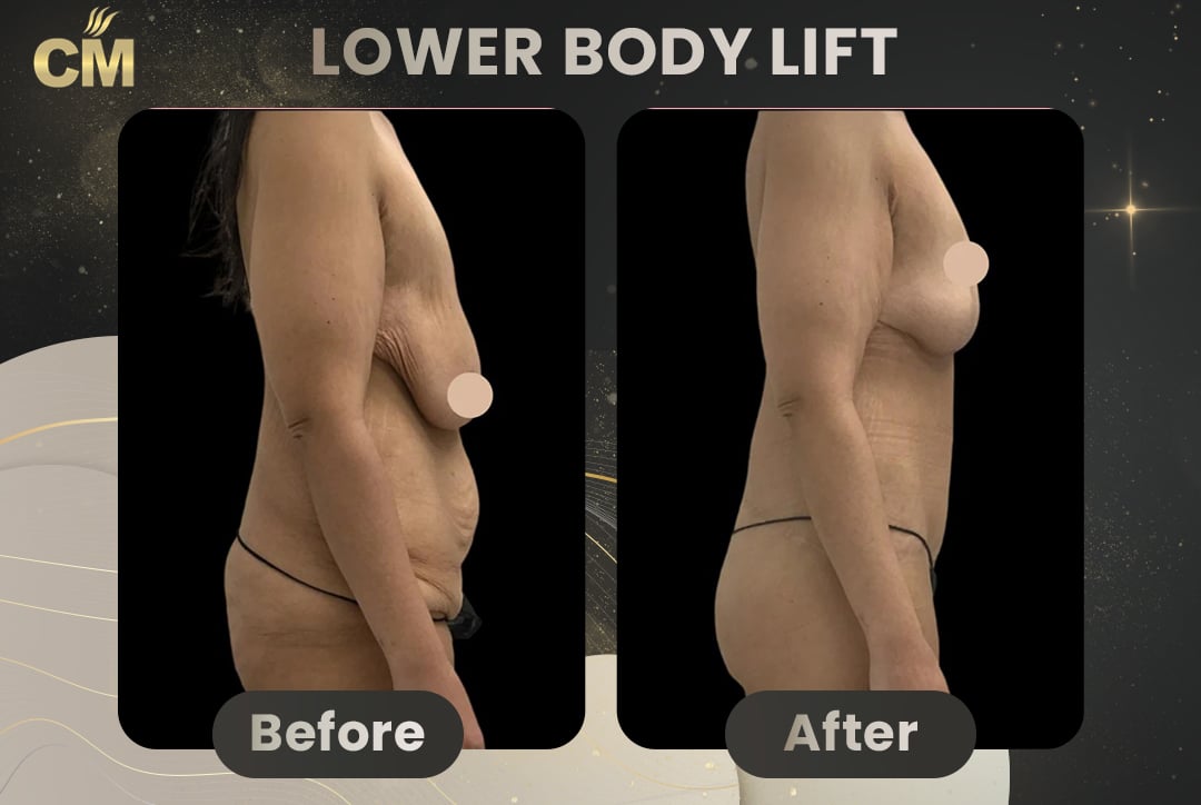 Back Lift (Bra Line Back Lift) Before After-1