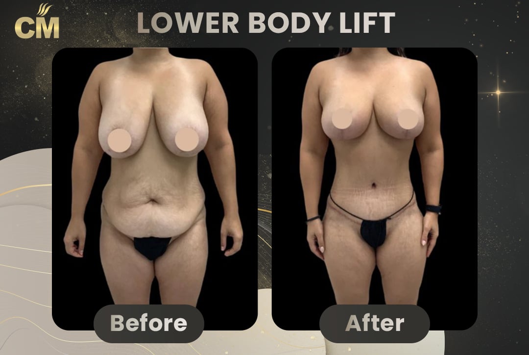Back Lift (Bra Line Back Lift) Before After-2