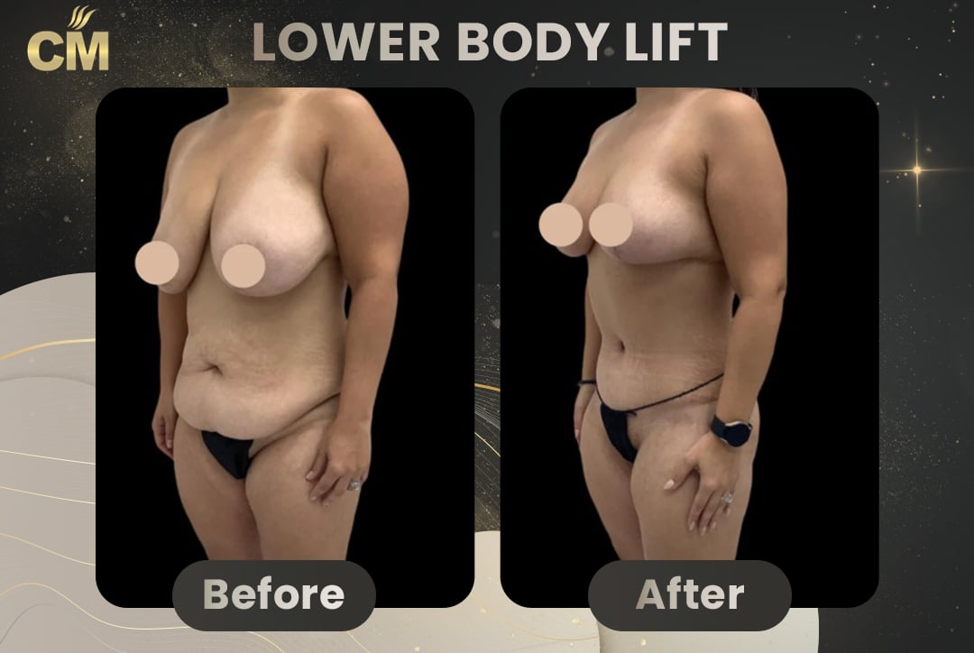 Back Lift (Bra Line Back Lift) Before After-3