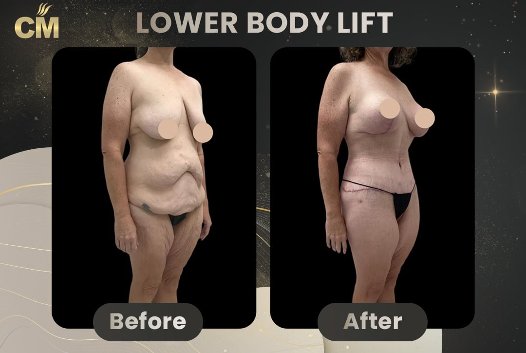 Back Lift (Bra Line Back Lift) Before After-5