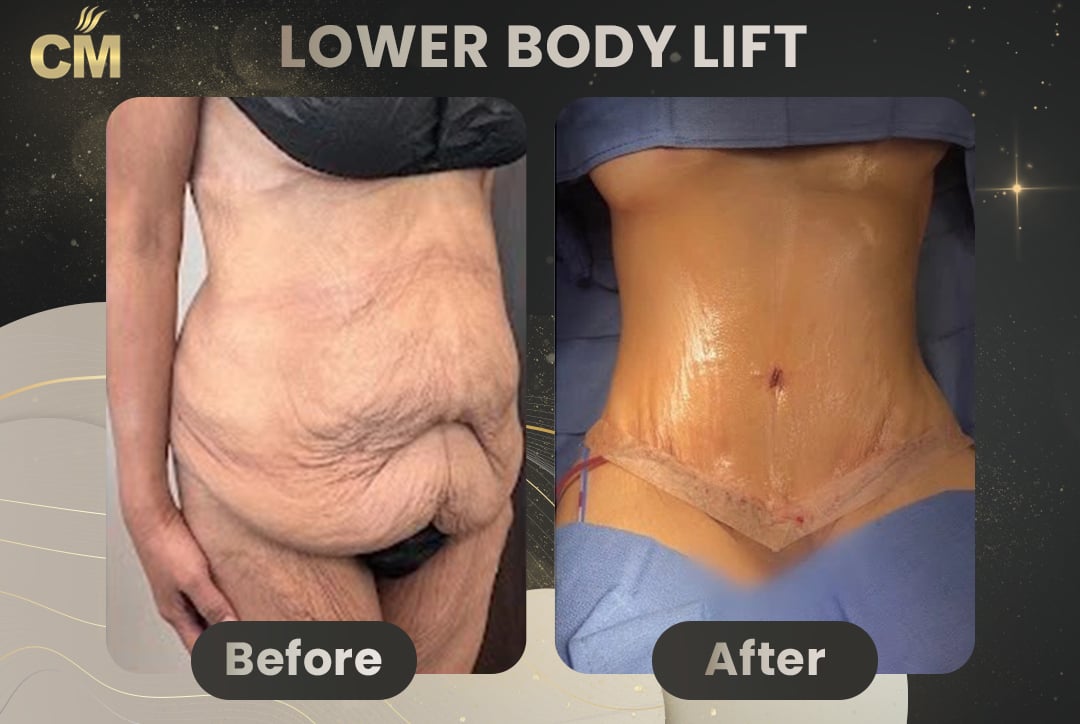 Back Lift (Bra Line Back Lift) Before After-6
