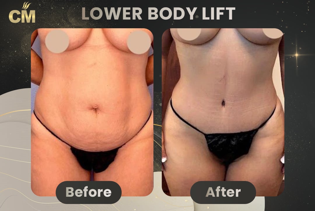 Back Lift (Bra Line Back Lift) Before After-7