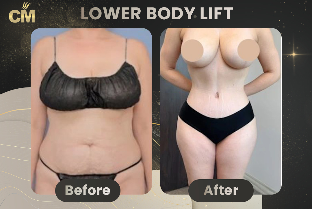 Back Lift (Bra Line Back Lift) Before After-8