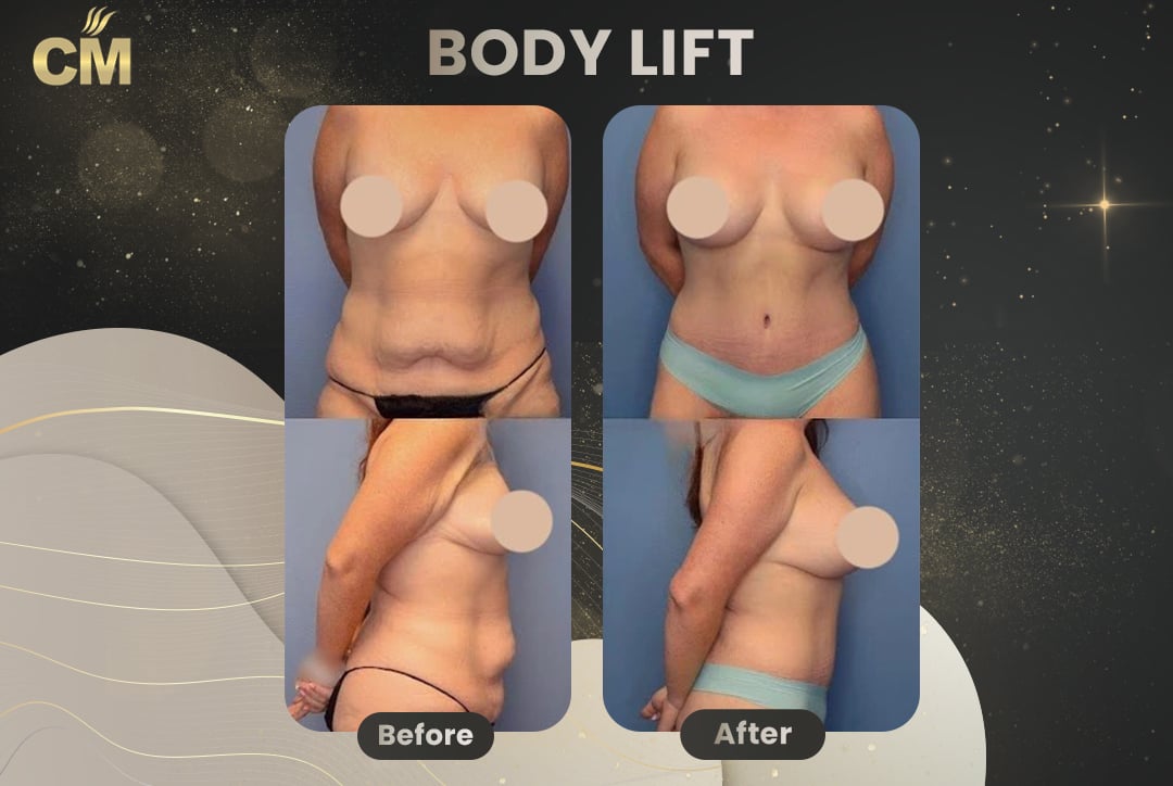 Back Lift (Bra Line Back Lift) Before After-9