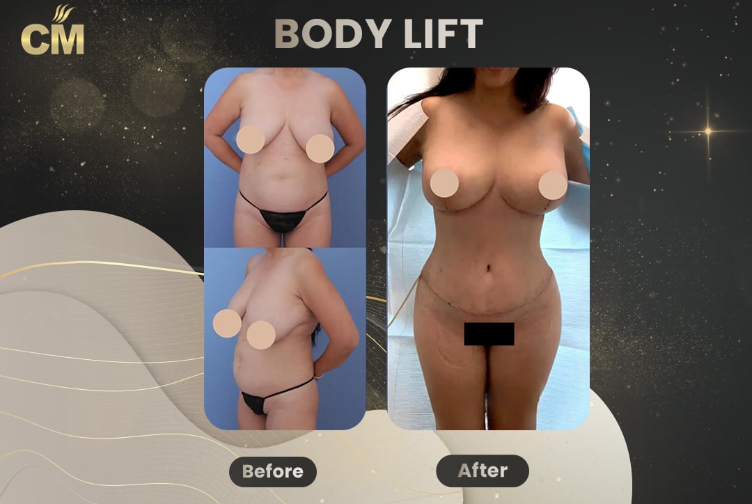 Back Lift (Bra Line Back Lift) Before After-11