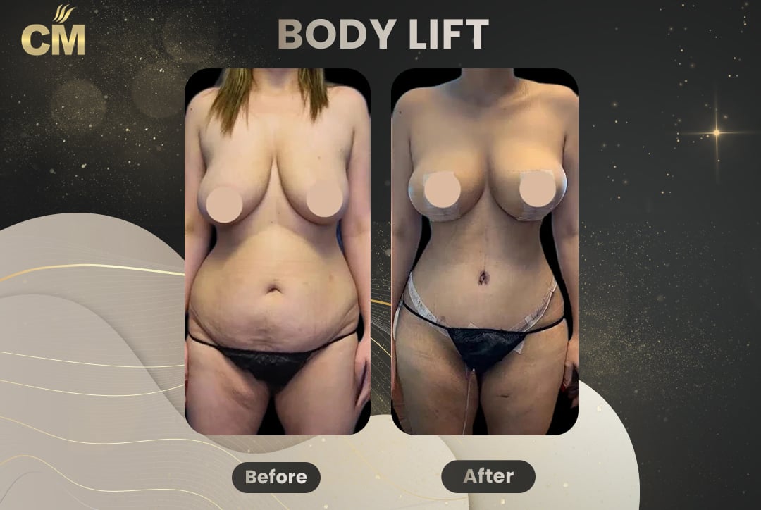 Back Lift (Bra Line Back Lift) Before After-12