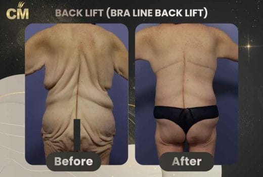 Back Lift (Bra Line Back Lift) Before After in turkey