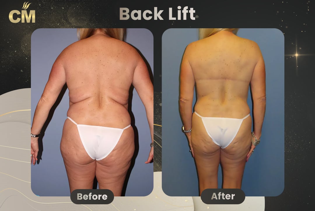 (Bra Line Back Lift) Back Lift Before and After in Turkey