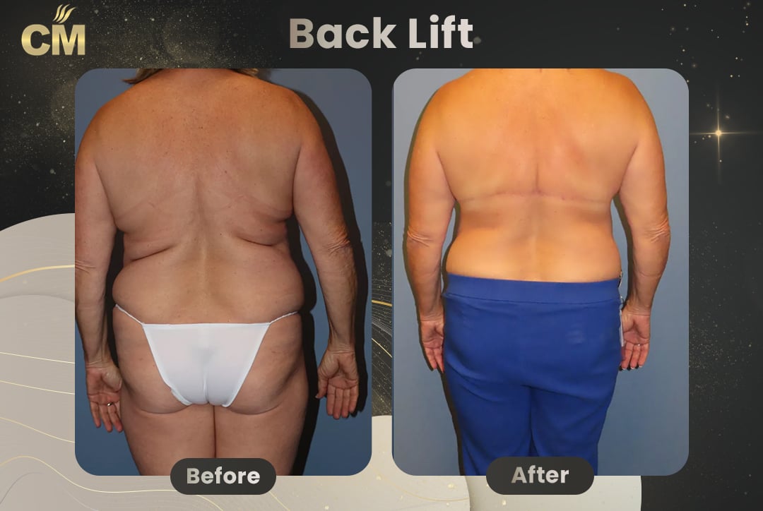 (Bra Line Back Lift) Back Lift Before and After in Turkey-1
