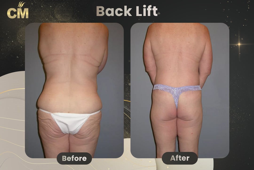 (Bra Line Back Lift) Back Lift Before and After in Turkey-2