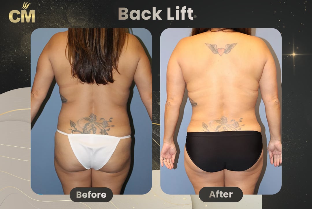 (Bra Line Back Lift) Back Lift Before and After in Turkey-3