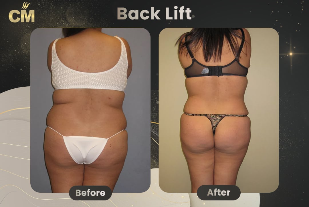 (Bra Line Back Lift) Back Lift Before and After in Turkey-4