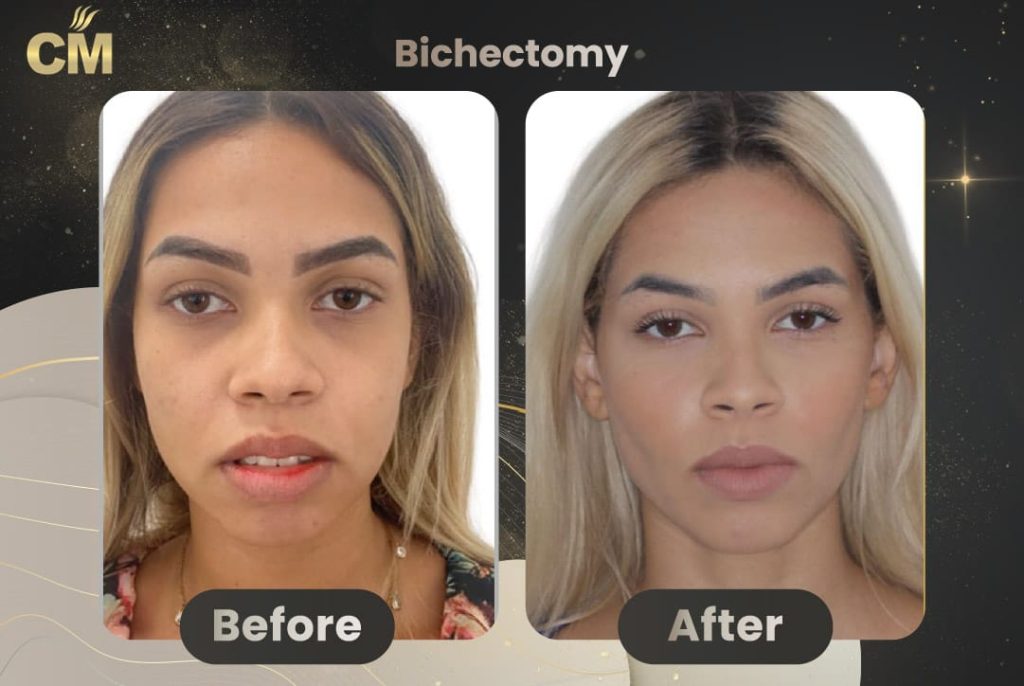 bichectomy before and after in turkey