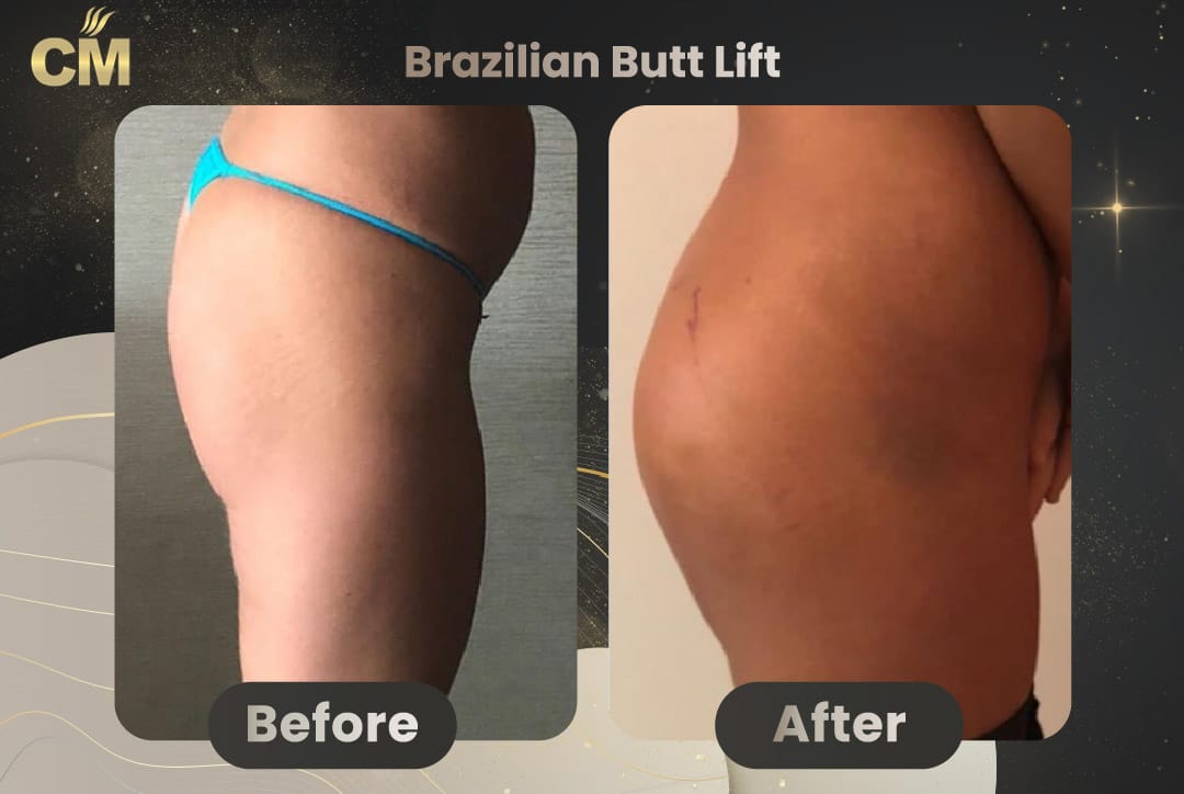 BBL Brazilian Butt Lift Before and After in Turkey-14