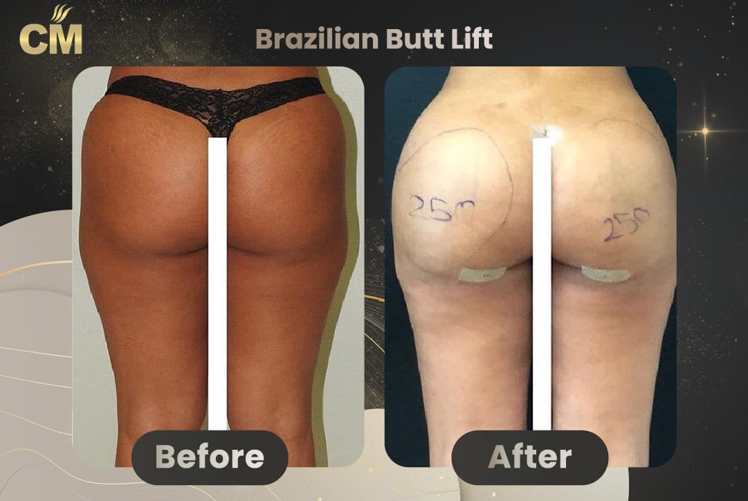 BBL Brazilian Butt Lift Before and After in Turkey-15