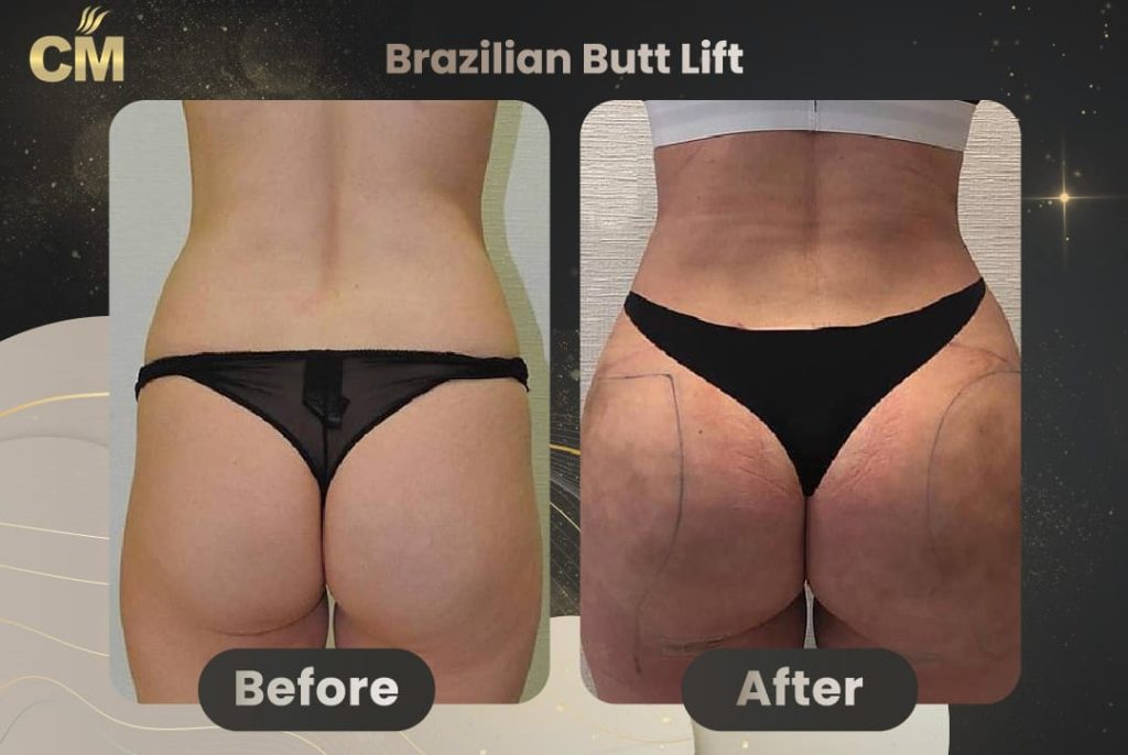 Brazilian Butt Lift Before and After in Turkey