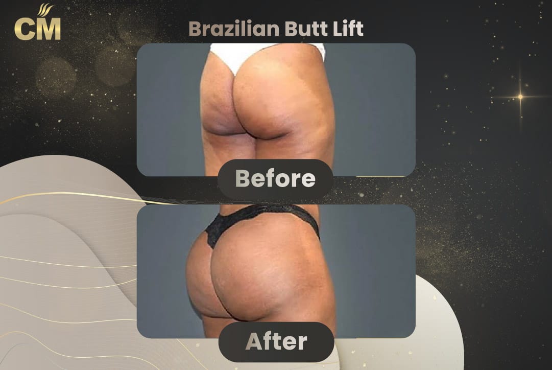 BBL Brazilian Butt Lift Before and After in Turkey-17