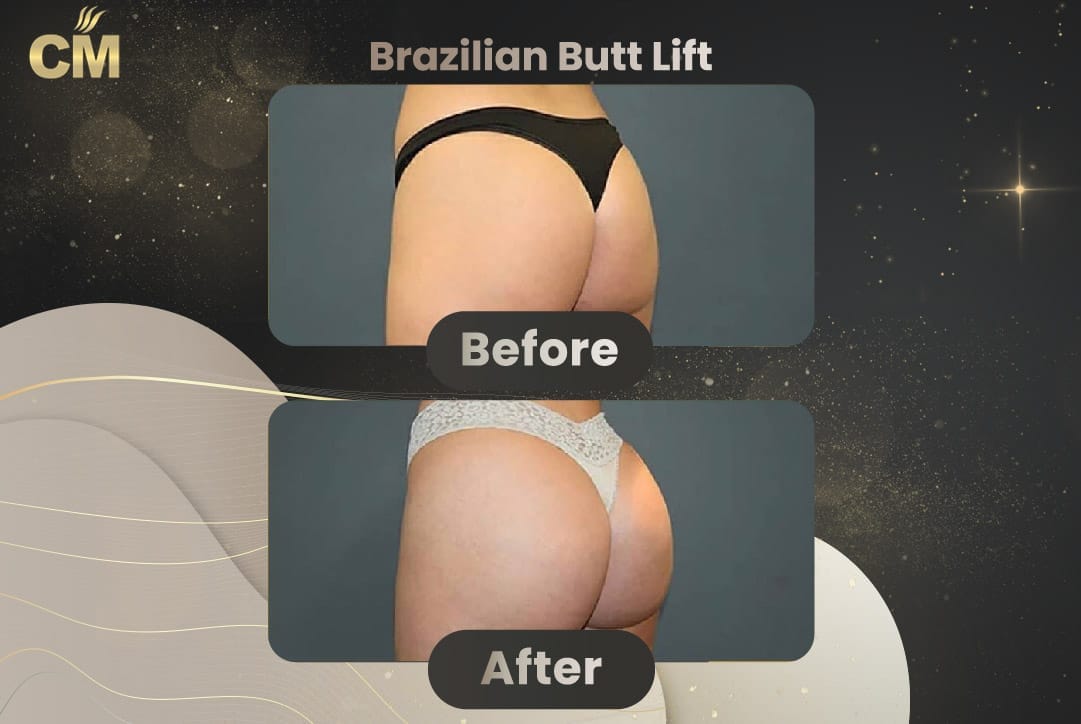 BBL Brazilian Butt Lift Before and After in Turkey-18