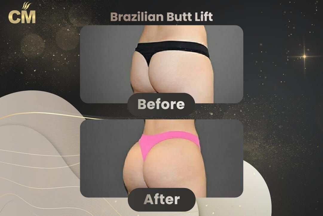 BBL Brazilian Butt Lift Before and After in Turkey-19