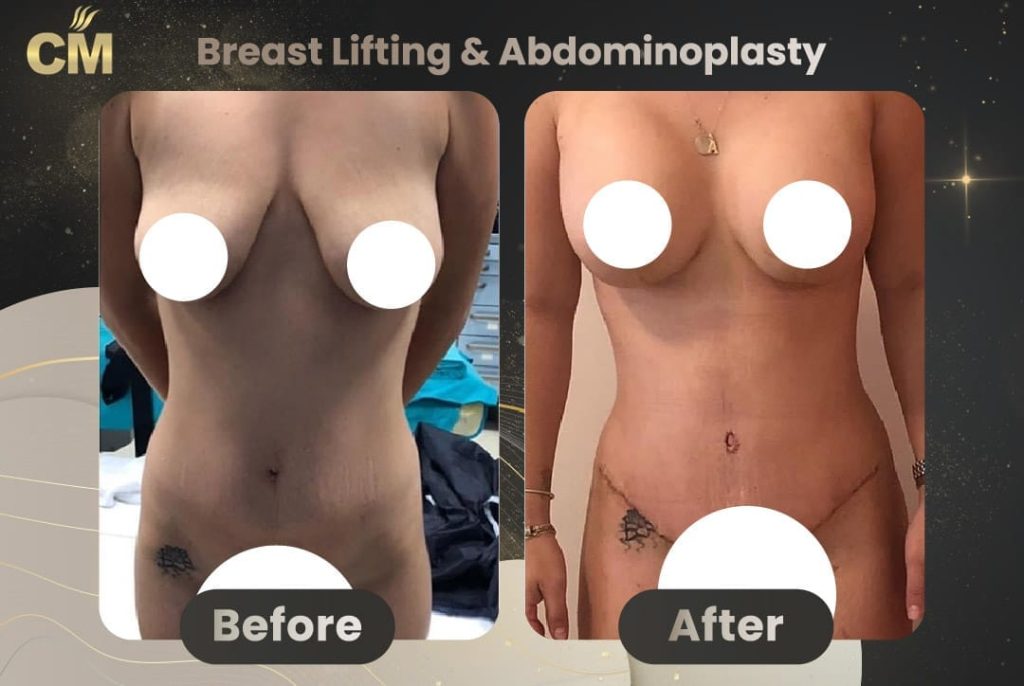 Breast Lift Before and After in Turkey