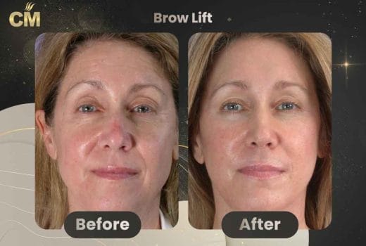 Brow lift before and after in turkey