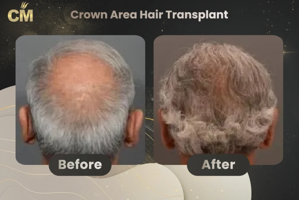 Crown Hair Transplant Before After in Turkey-2