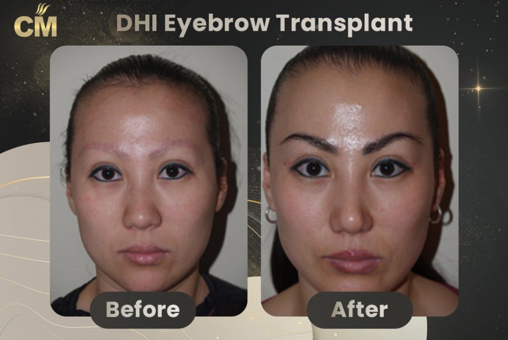 DHI Eyebrow Transplant Before After