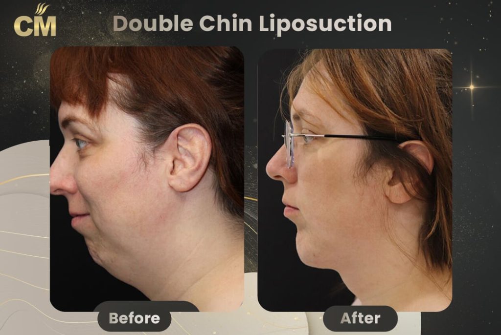 Double Chin Liposuction Before and After in Turkey