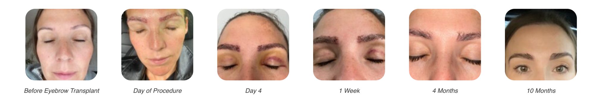 Eyebrow transplant timeline