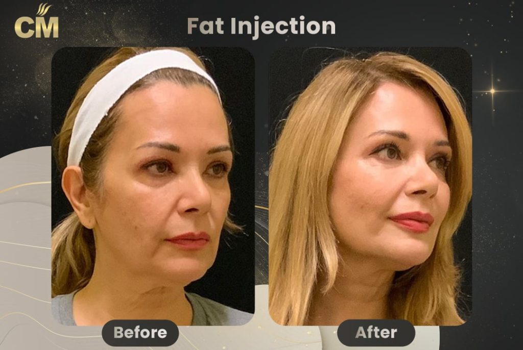 Fat Injection Before After in Turkey